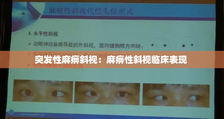 突发性麻痹斜视：麻痹性斜视临床表现 